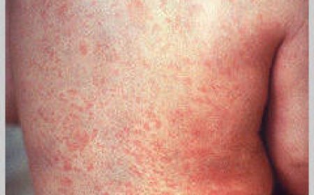 ରୁବେଲା ଭାଇରସ୍କୁ ନେଇ ସ୍ୱାସ୍ଥ୍ୟ ସଚିବଙ୍କ ବିଶେଷ ପରାମର୍ଶ