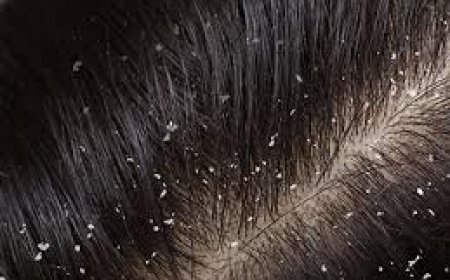 ରୁପି ହେବାର  କାରଣ ?