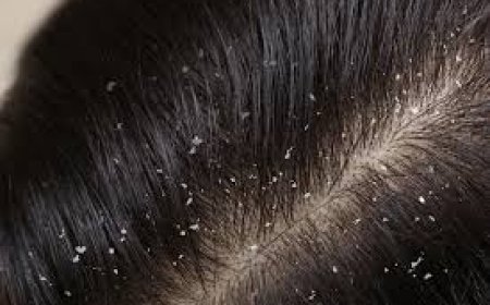 ରୁପି ସମସ୍ୟା ର କାରଣ ଓ ନିୟନ୍ତ୍ରଣ ?