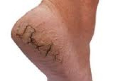 ଗୋଇଠି ଫାଟିବା ଦିଏ ମାରାତ୍ମକ ରୋଗର ସଙ୍କେତ