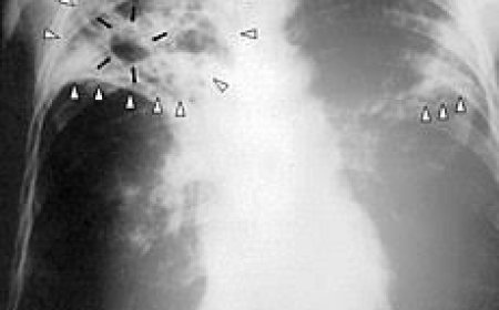 ଯକ୍ଷ୍ମା ରୋଗ : କିଛି କଥା