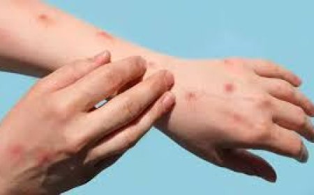 କେରଳରେ ଆଉ ଜଣେ ଏମ୍‌ପକ୍ସ ଆକ୍ରାନ୍ତ