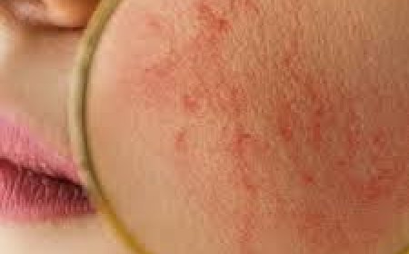 ସ୍କିନ୍‌ ଆଲର୍ଜି ଅଛି କି?  ଆପଣାନ୍ତୁ ଘରୋଇ ଉପାୟ