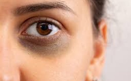 ଆଖିତଳ କଳା ପଡ଼ୁଥିଲେ…ଆପଣାନ୍ତୁ ଏହି ଟିପ୍ସ !