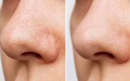 ବ୍ଲାକ୍‌ ହେଡ୍ସ ନେଇ ଚିନ୍ତିତ କି?