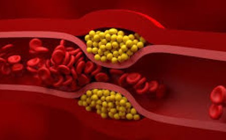 ‘ଖରାପ କୋଲେଷ୍ଟ୍ରଲ’ ହୃଦରୋଗ ଆଶଙ୍କା ବୃଦ୍ଧି